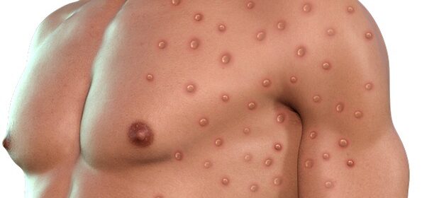 monkeypox
