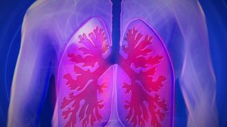 Tuberculosis cases rising in county, state